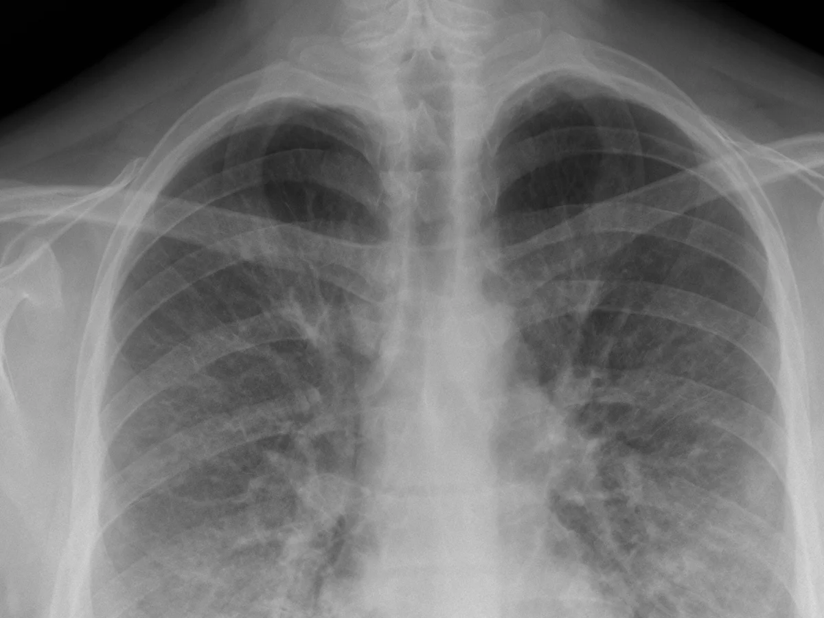 Pneumonia Detection Screenshot